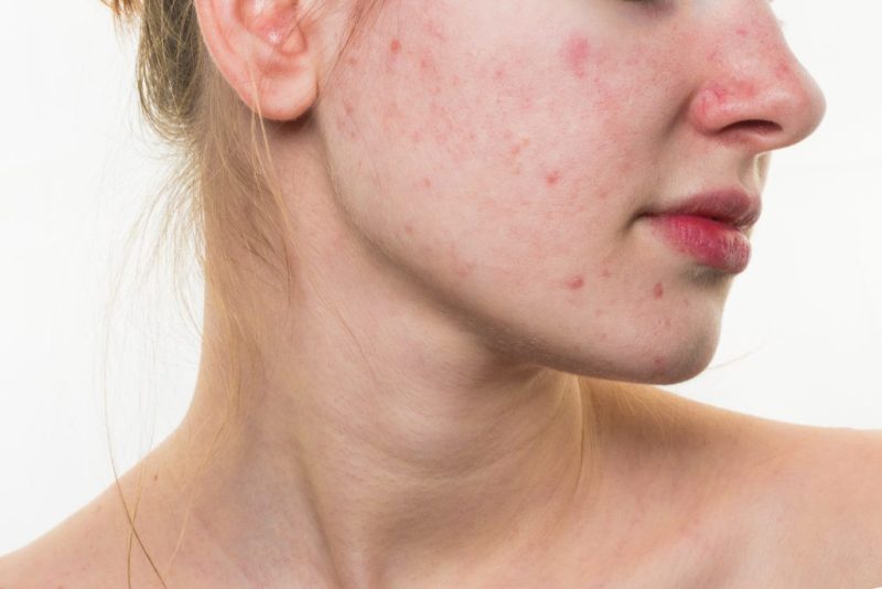 Here is Everything You Need to Know about Curing Acne and More
