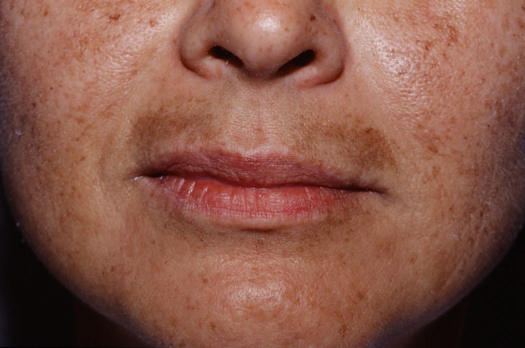 How To Lighten Up Dull And Blotchy Skin Naturally lighten up dull and blotchy skin naturally