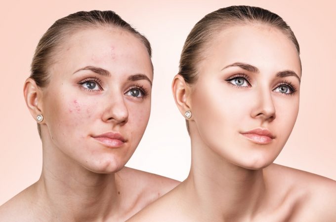 The Skin Before and after Acne Removal by the Experts