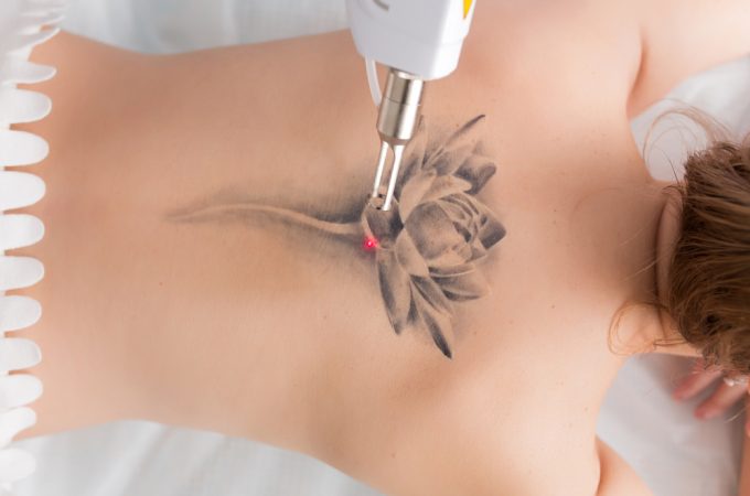 How to Find a Reliable Tattoo Removal Service