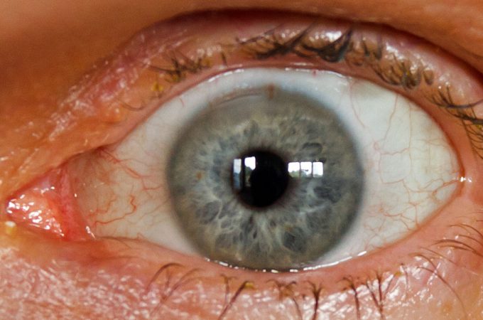 Everything You Need to Know About Cataract Eye Surgery