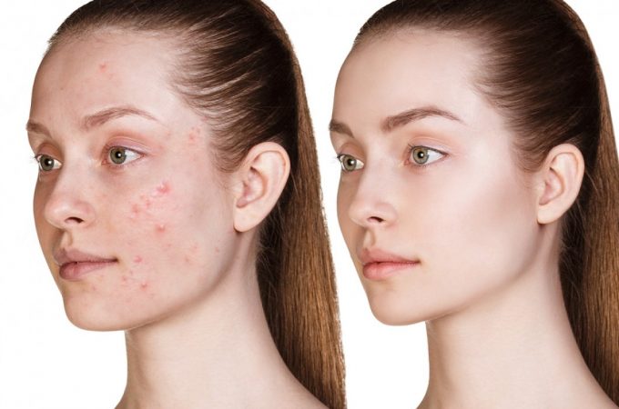 Planning to Go for an Acne Treatment