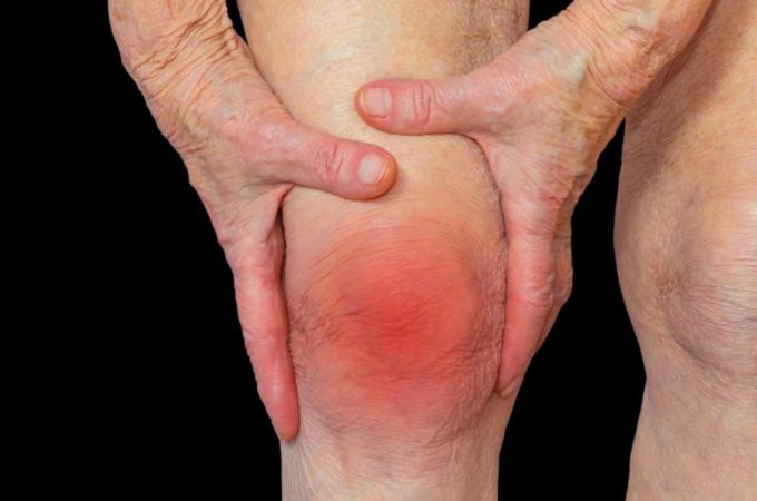Osteoarthritis: The Most Common Form of Arthritis