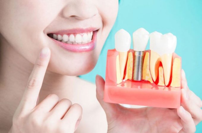 All On 4 Dental Implants: What to Know Before You Consider