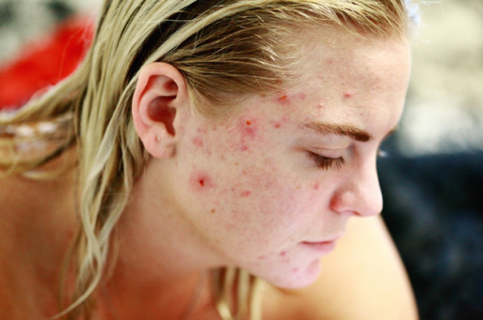 Acne a Skin Condition – Causes, Symptoms and Treatment