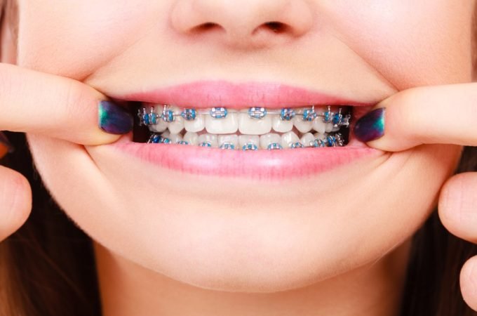 The Full Guide of Having Braces