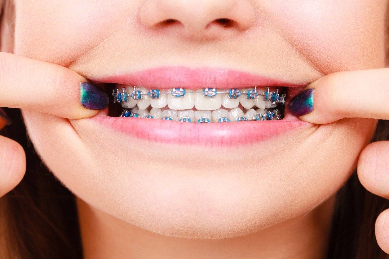 The Full Guide Of Having Braces 