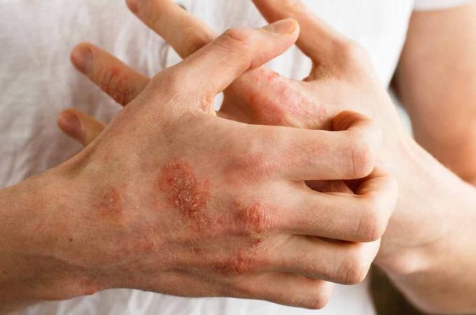 Top Home Remedies for Eczema
