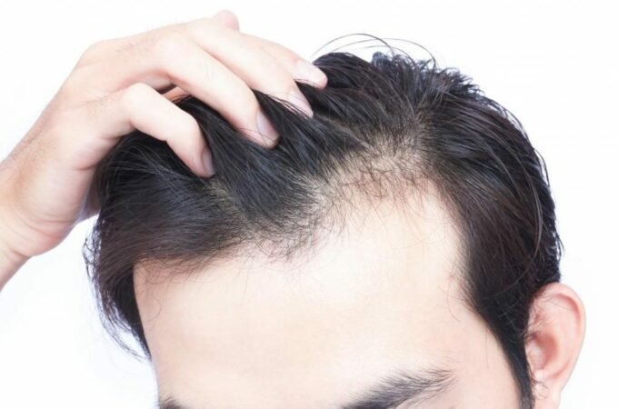 Hair Loss: How Hair Transplant Can Help?