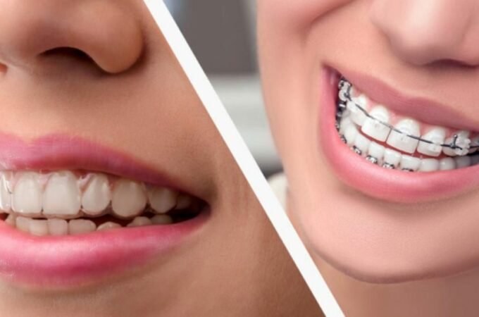 All About Invisalign Braces