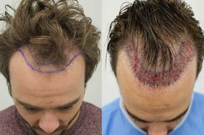 Should You Get a Hair Transplant?