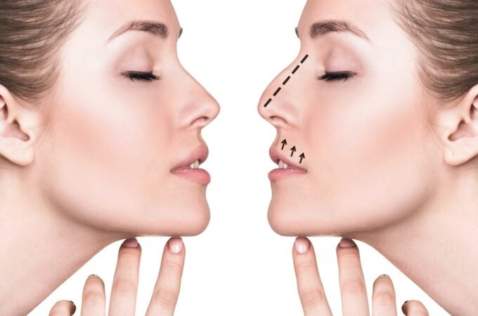 Rhinoplasty Techniques, Explained