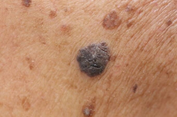 Types of Moles that Increase Risk of Melanoma