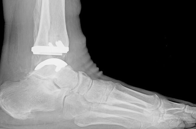 Reasons to Get Total Ankle Replacement