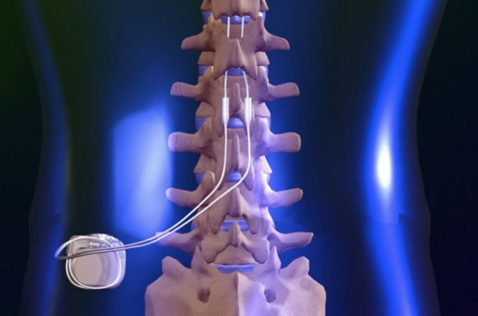 Important Facts About Spinal Cord Stimulation