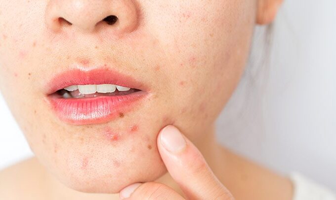 Signs of Hormonal Acne and Hormonal Acne Treatment