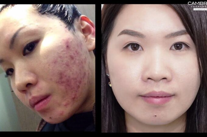Options for Effective Acne Treatment in Singapore
