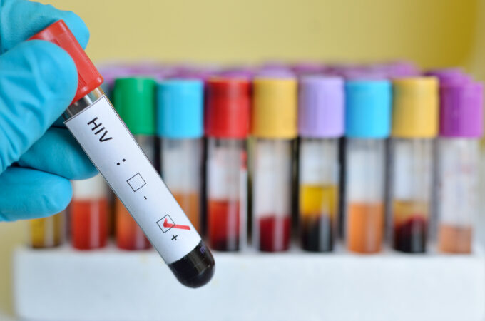 Why HIV Testing Should be Encouraged