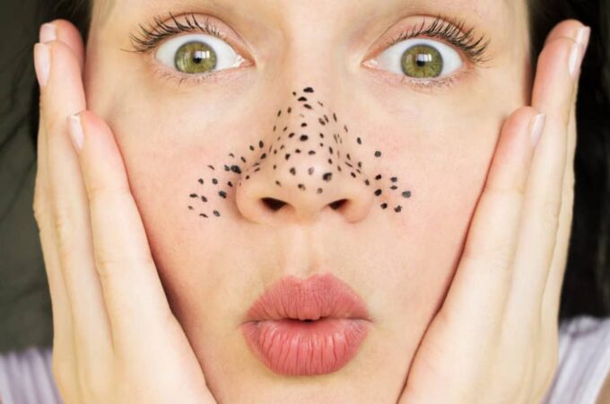 5 Ultimate Tips to Get Rid of Blackheads
