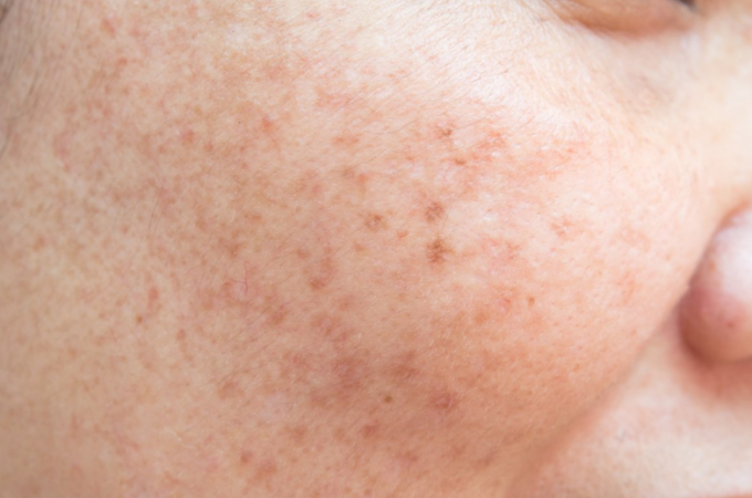 Important Questions That You Need To Answer Before Getting Acne Scar Removal