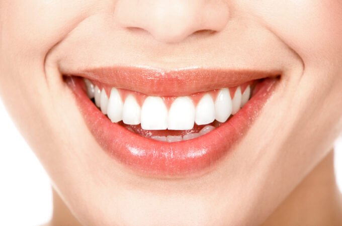 Are All on 4 Dental Implants Better than Traditional Implants?