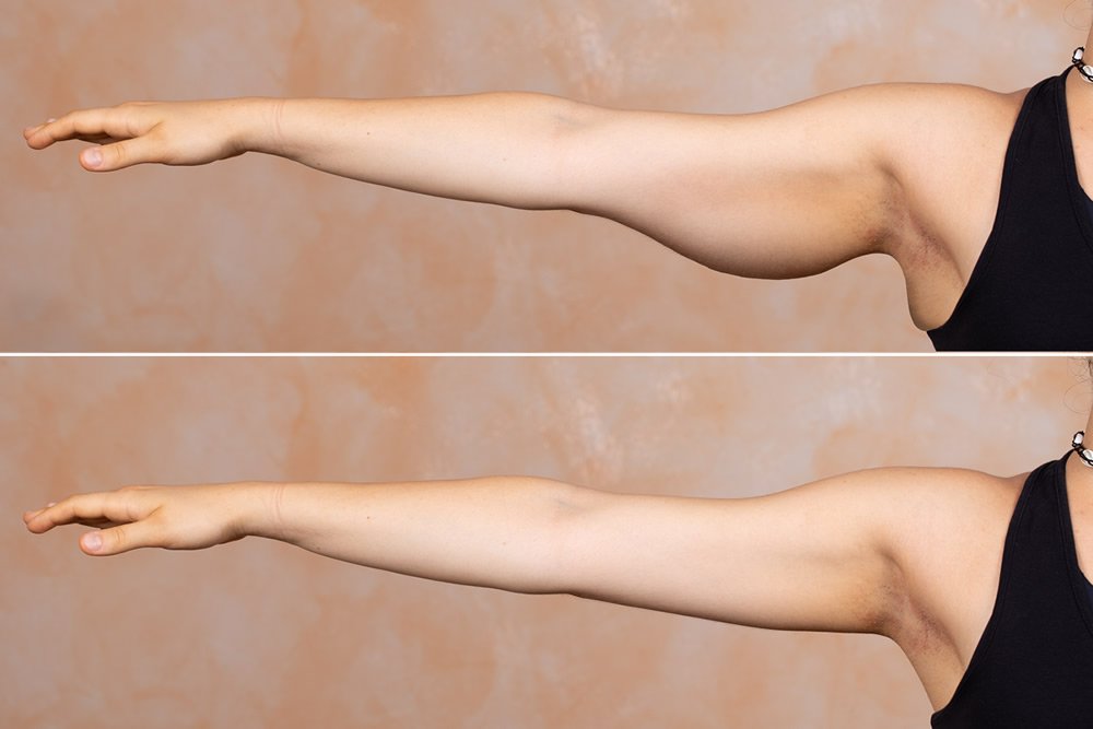 How to Freeze Your Arm Fat Off