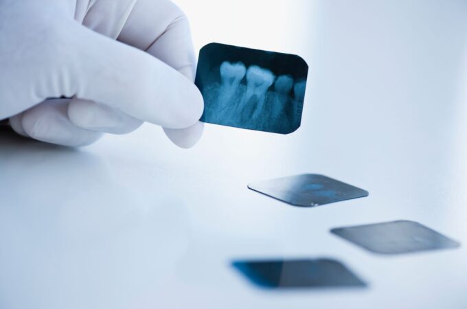 How Often Should You Get Tooth X-rays?