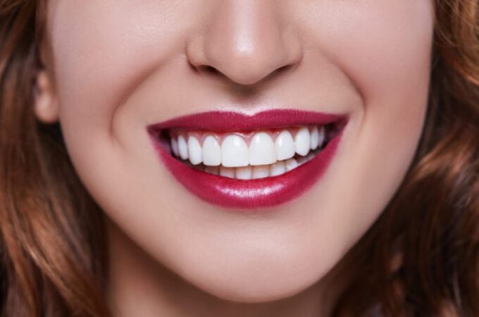 Perfect Smile with Dental Veneers