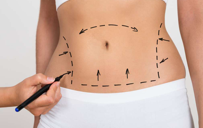 Should You Go For Liposuction Or A Tummy Tuck?