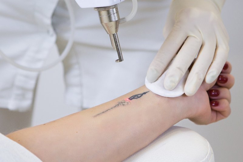 Tattoo Removal is a Feasible Option Today, But the Results