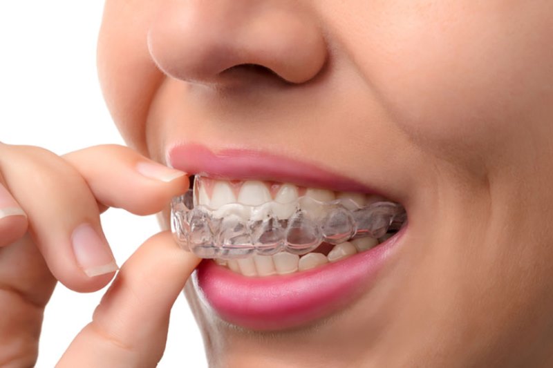 How to Make the Most Out of Your Invisible Braces
