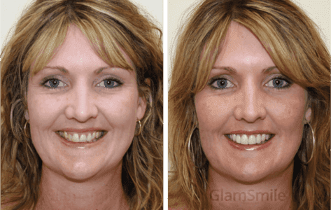 4 Popular Affordable Cosmetic Dentistry Procedures