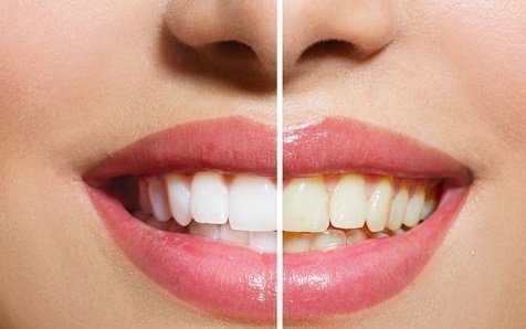 How Do Toorak Dentists Treat Teeth Grinding in Children