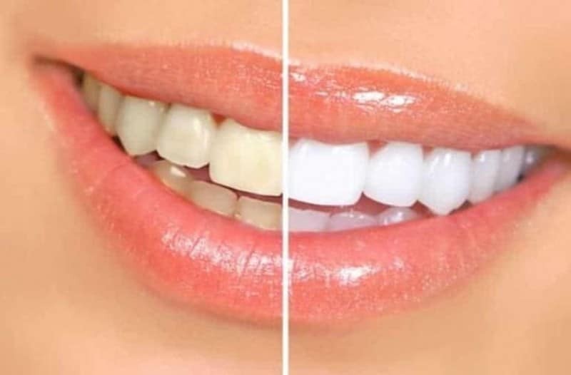 Post Teeth Whitening Tips