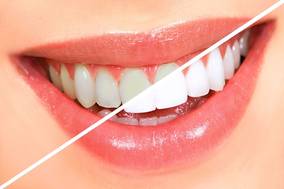SHOULD YOU CONSIDER TOOTH WHITENING? THE BENEFITS OF A PROFESSIONAL TREATMENT
