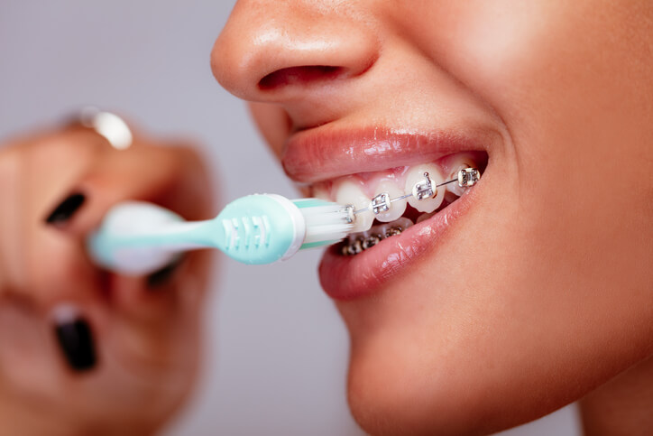 Why Is It Important to Avoid Cavities With Braces?