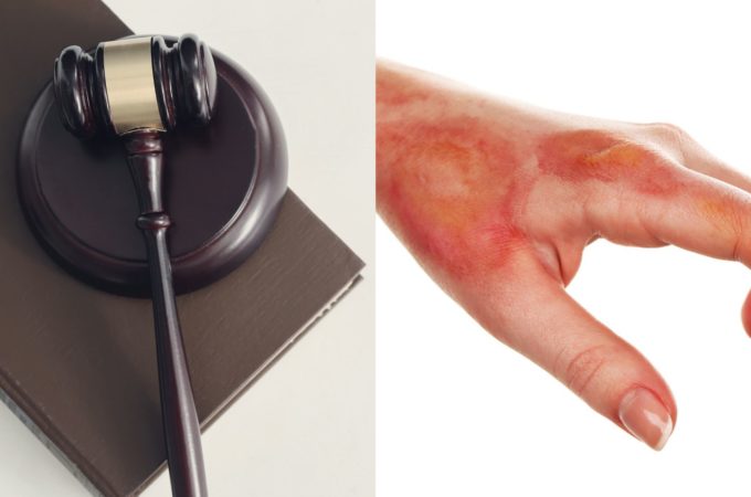 Understanding the Legal Ramifications of a Burn Injury Lawsuit